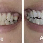 Zoom Teeth Whitening
