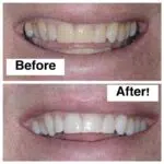 Zoom Teeth Whitening