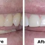 A brighter smile in two hours